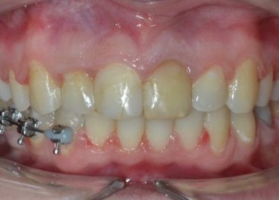 Лечение глубокого прикуса и сужения верхнего зубного ряда